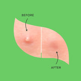 Fundamentals - Get the Zit out Hydrocollide Pimple Patches